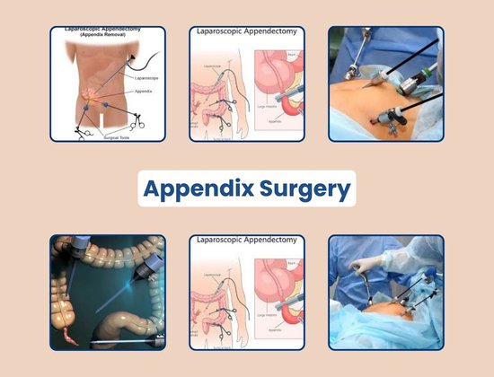 Appendix Surgery