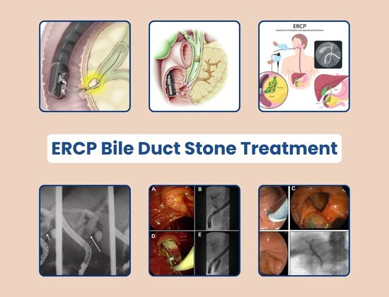 ERCP Surgery