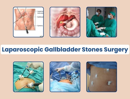Gallbladder Surgery