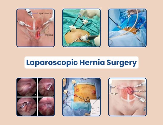 Laparoscopic hernia Surgery