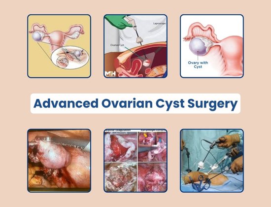 Ovarain Cyst